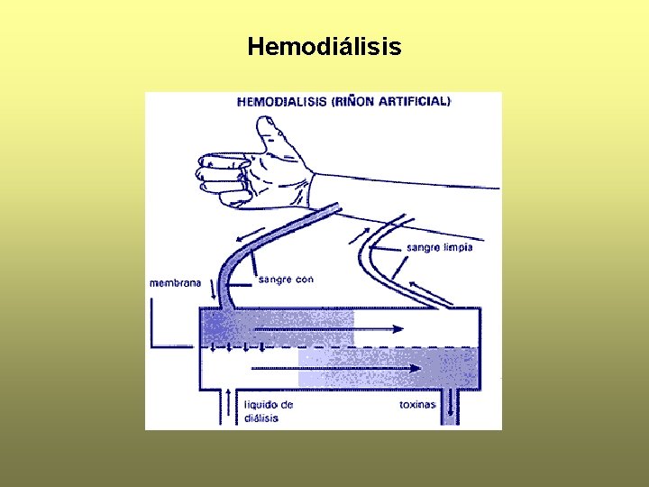 Hemodiálisis 