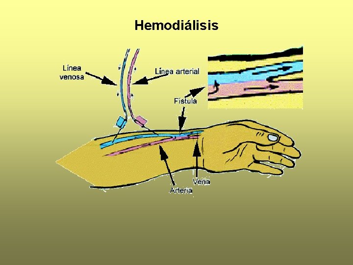 Hemodiálisis 