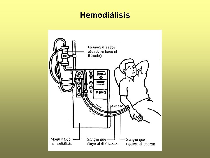 Hemodiálisis 