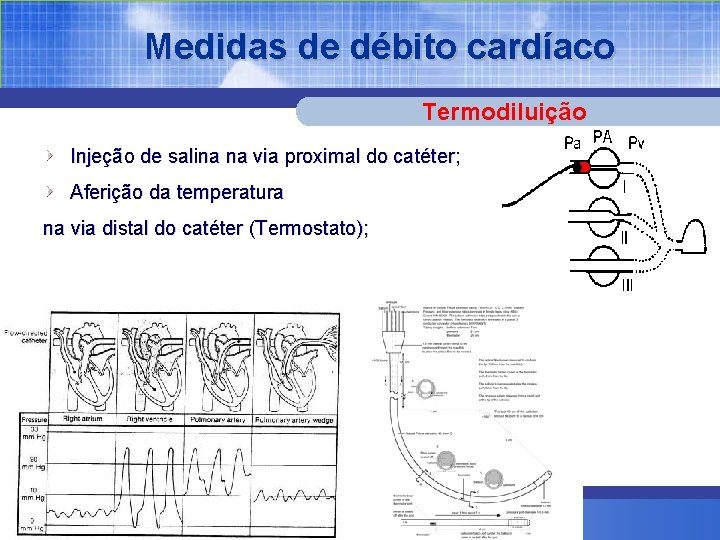 Medidas de débito cardíaco Termodiluição Injeção de salina na via proximal do catéter; Aferição
