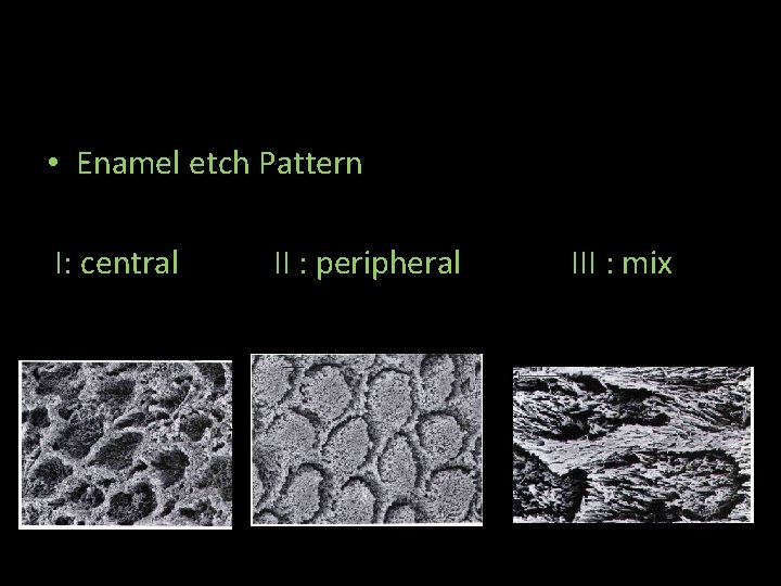  • Enamel etch Pattern I: central II : peripheral III : mix 