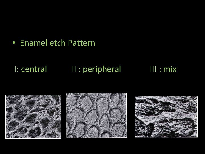 • Enamel etch Pattern I: central II : peripheral III : mix • Enamel etch Pattern I: central II : peripheral III : mix