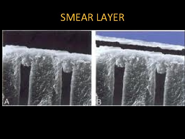 SMEAR LAYER SMEAR LAYER