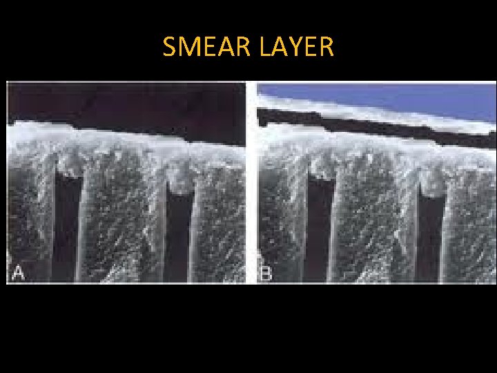 SMEAR LAYER 