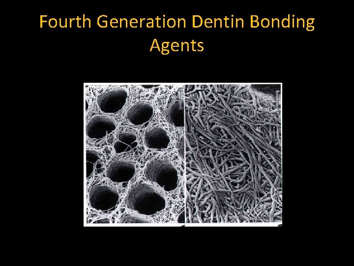 Fourth Generation Dentin Bonding Agents Fourth Generation Dentin Bonding Agents