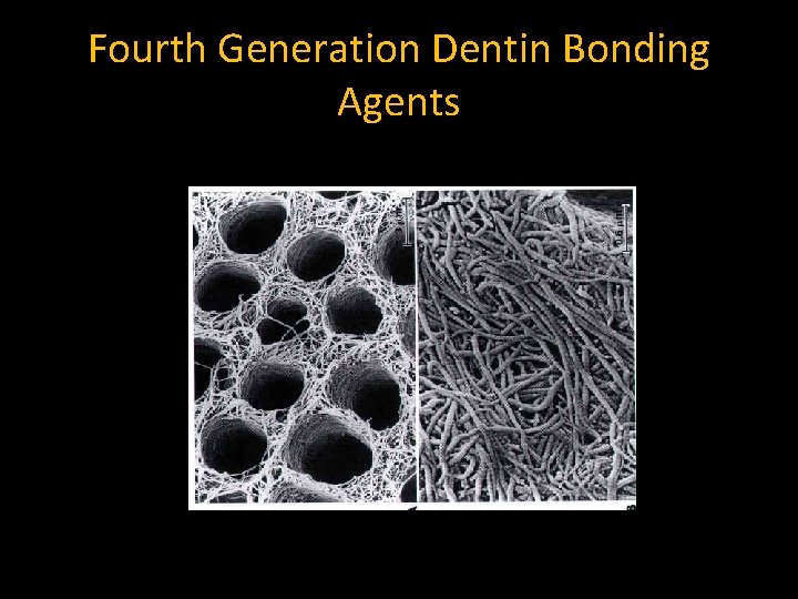 Fourth Generation Dentin Bonding Agents 