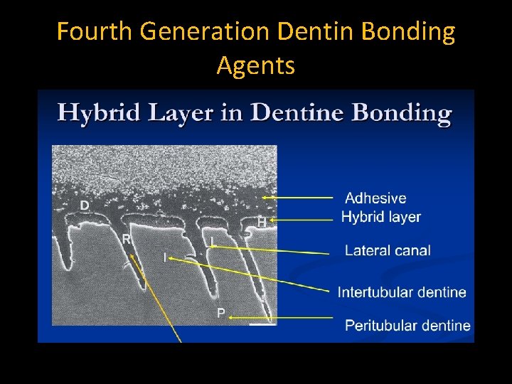 Fourth Generation Dentin Bonding Agents Fourth Generation Dentin Bonding Agents