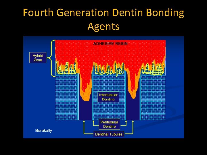 Fourth Generation Dentin Bonding Agents 