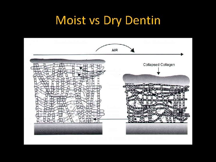Moist vs Dry Dentin 
