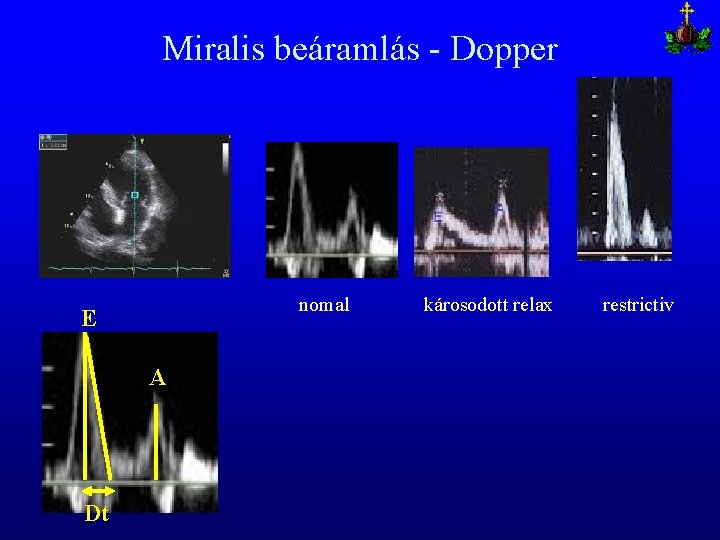 Miralis beáramlás - Dopper nomal E A Dt károsodott relax restrictiv 