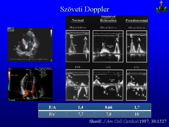 Szöveti Doppler E/A 1, 4 0, 66 1, 7 E/e` 7, 7 7, 8