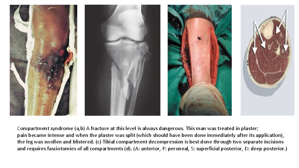 Compartment syndrome (a, b) A fracture at this level is always dangerous. This man