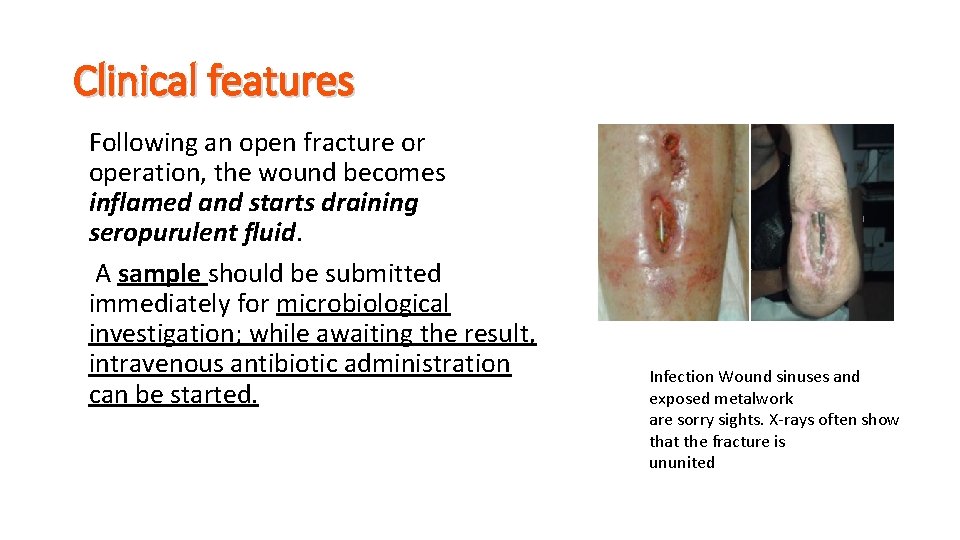 Clinical features Following an open fracture or operation, the wound becomes inflamed and starts