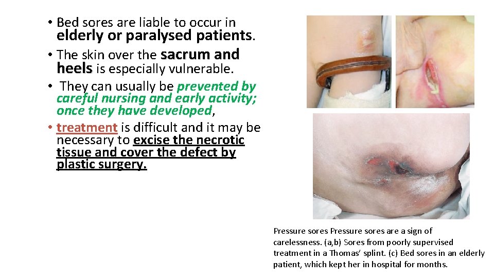  • Bed sores are liable to occur in elderly or paralysed patients. •