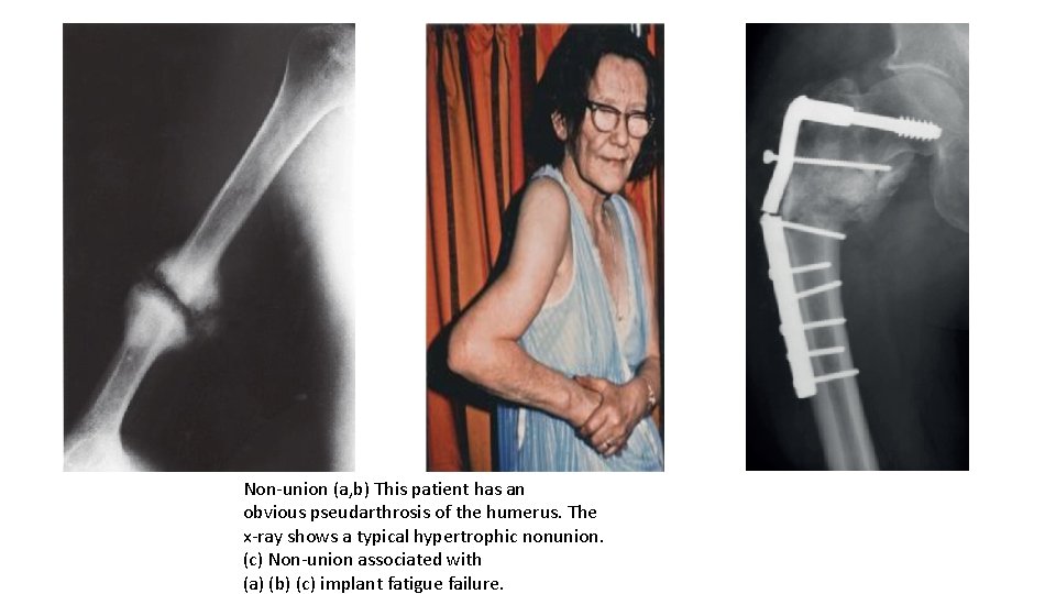Non-union (a, b) This patient has an obvious pseudarthrosis of the humerus. The x-ray