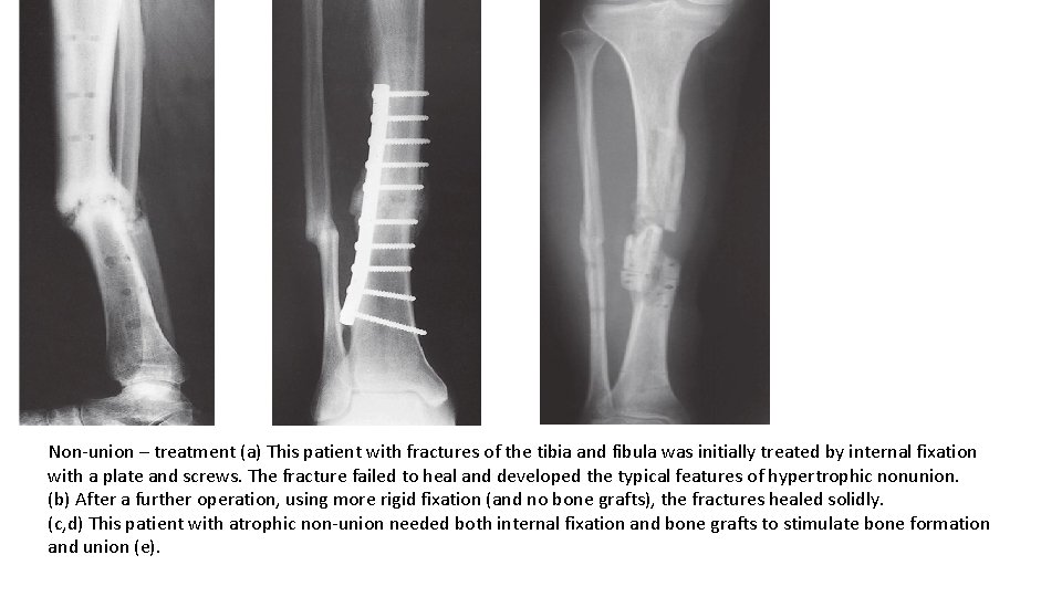 Non-union – treatment (a) This patient with fractures of the tibia and fibula was