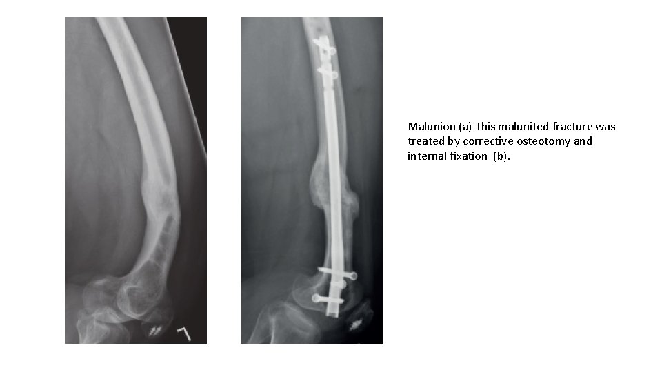 Malunion (a) This malunited fracture was treated by corrective osteotomy and internal fixation (b).