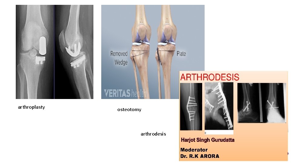 arthroplasty osteotomy arthrodesis 