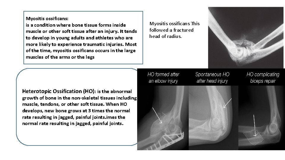 Myositis ossificans: is a condition where bone tissue forms inside muscle or other soft