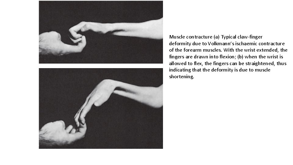 Muscle contracture (a) Typical claw-finger deformity due to Volkmann’s ischaemic contracture of the forearm