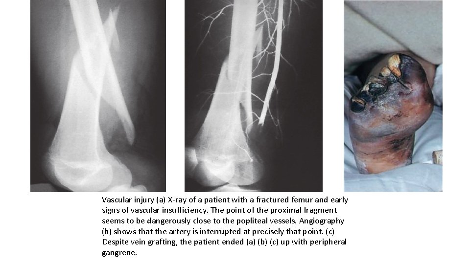 Vascular injury (a) X-ray of a patient with a fractured femur and early signs