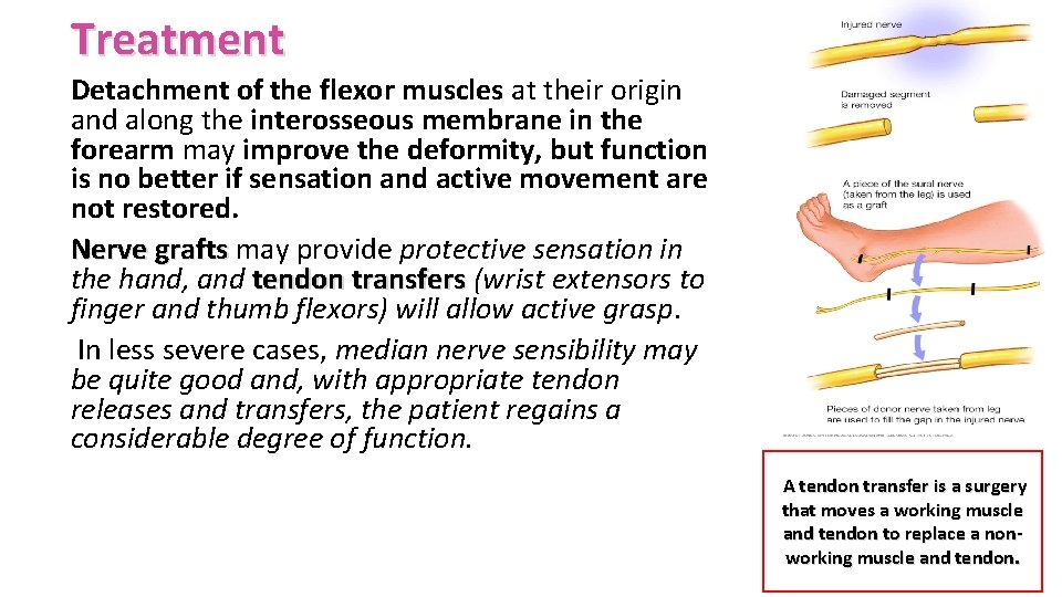 Treatment Detachment of the flexor muscles at their origin and along the interosseous membrane