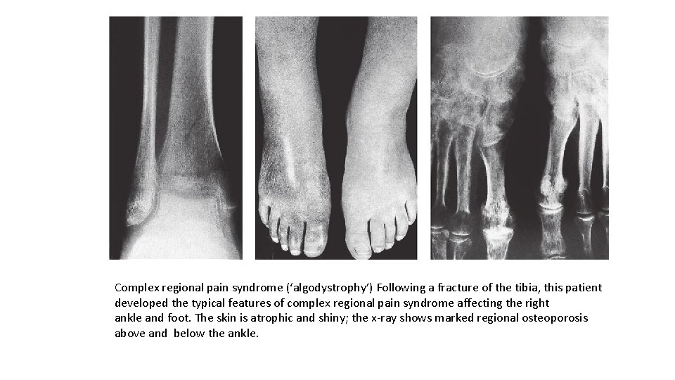 Complex regional pain syndrome (‘algodystrophy’) Following a fracture of the tibia, this patient developed