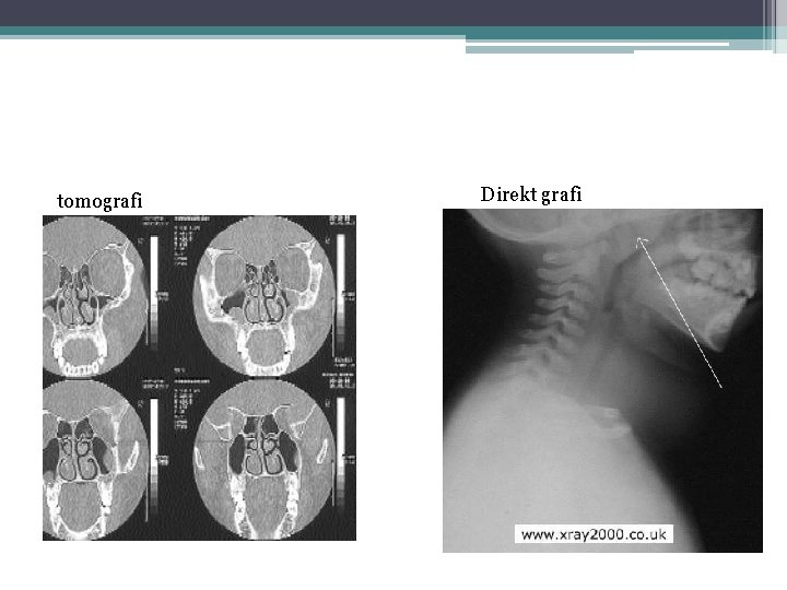 tomografi Direkt grafi 