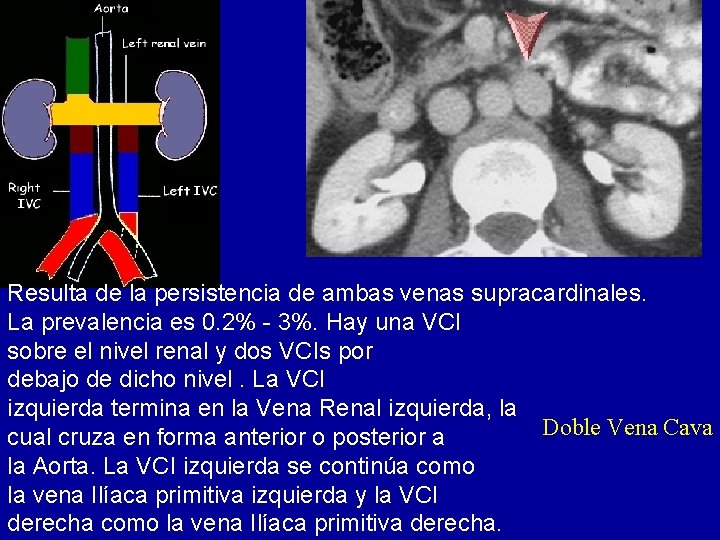 Resulta de la persistencia de ambas venas supracardinales. La prevalencia es 0. 2% -