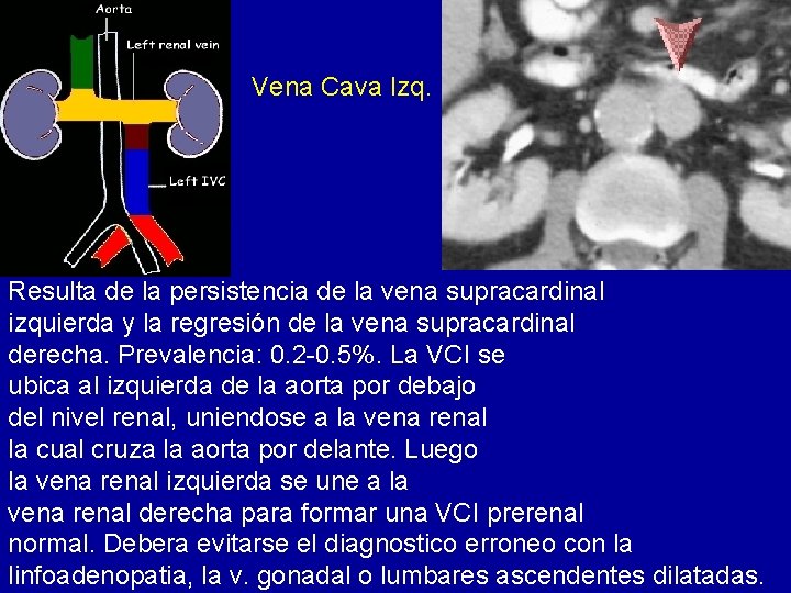 Vena Cava Izq. Resulta de la persistencia de la vena supracardinal izquierda y la