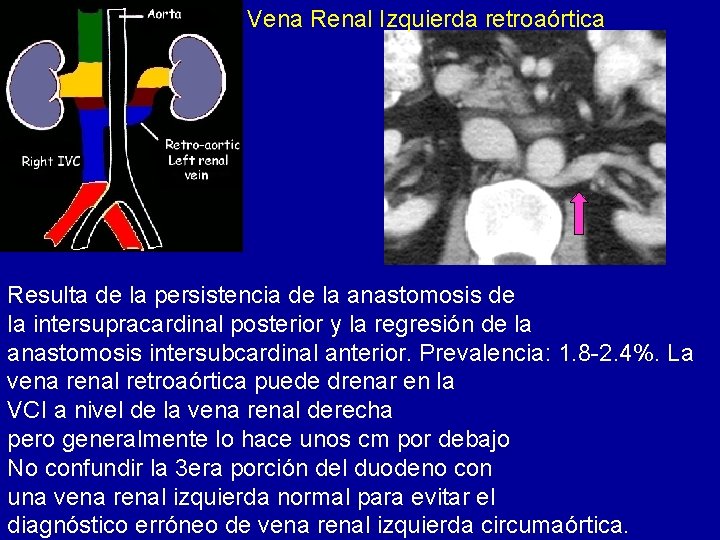 Vena Renal Izquierda retroaórtica Resulta de la persistencia de la anastomosis de la intersupracardinal