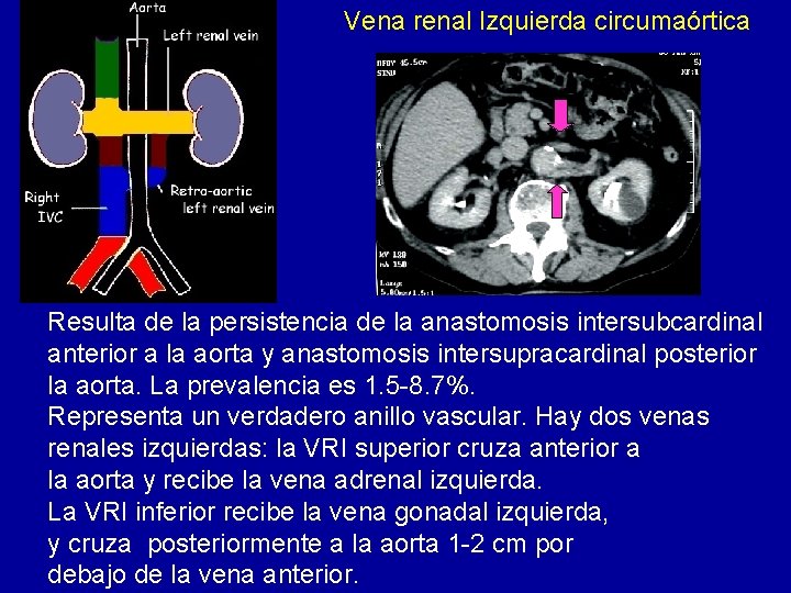 Vena renal Izquierda circumaórtica Resulta de la persistencia de la anastomosis intersubcardinal anterior a