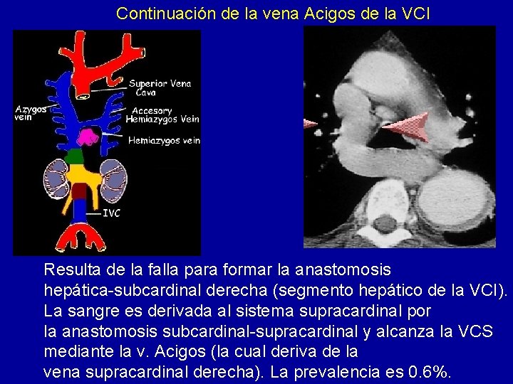 Continuación de la vena Acigos de la VCI Resulta de la falla para formar