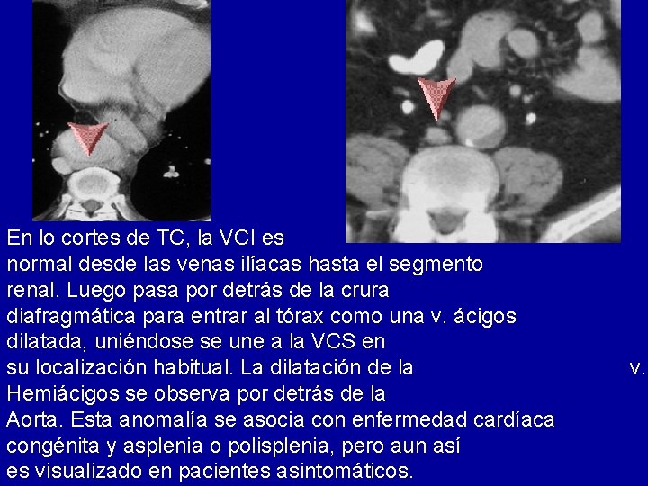 En lo cortes de TC, la VCI es normal desde las venas ilíacas hasta