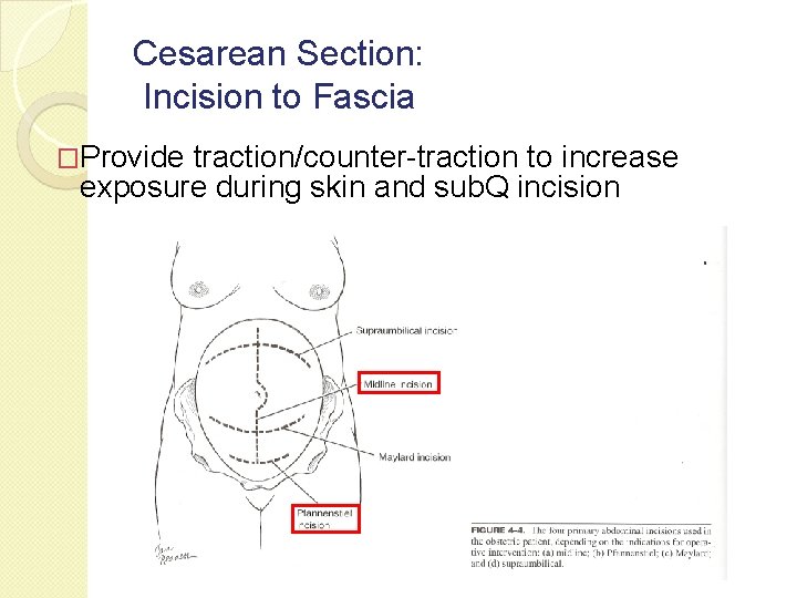 Cesarean Section: Incision to Fascia �Provide traction/counter-traction to increase exposure during skin and sub.