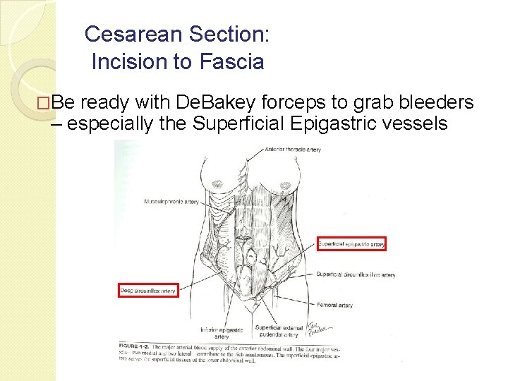 Cesarean Section: Incision to Fascia �Be ready with De. Bakey forceps to grab bleeders