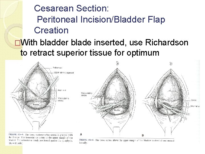 Cesarean Section: Peritoneal Incision/Bladder Flap Creation �With bladder blade inserted, use Richardson to retract