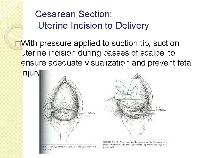 Cesarean Section: Uterine Incision to Delivery �With pressure applied to suction tip, suction uterine