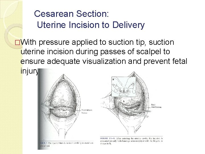 Cesarean Section: Uterine Incision to Delivery �With pressure applied to suction tip, suction uterine Cesarean Section: Uterine Incision to Delivery �With pressure applied to suction tip, suction uterine