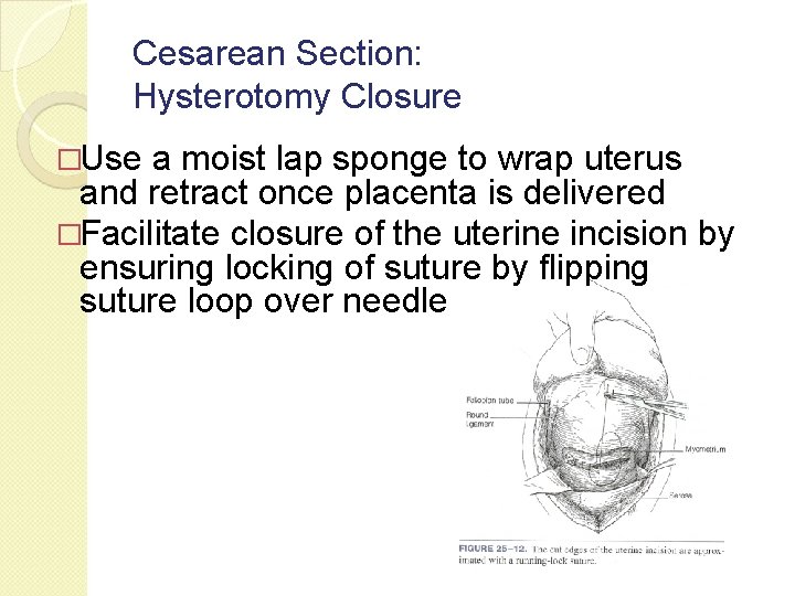 Cesarean Section: Hysterotomy Closure �Use a moist lap sponge to wrap uterus and retract Cesarean Section: Hysterotomy Closure �Use a moist lap sponge to wrap uterus and retract