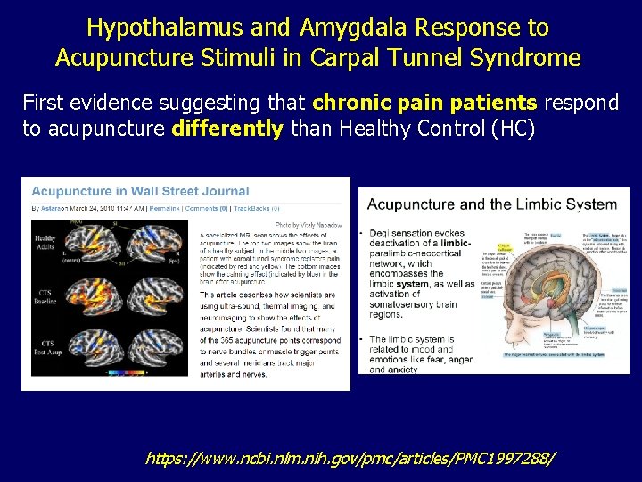 Hypothalamus and Amygdala Response to Acupuncture Stimuli in Carpal Tunnel Syndrome First evidence suggesting