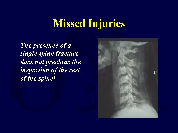 Missed Injuries The presence of a single spine fracture does not preclude the inspection