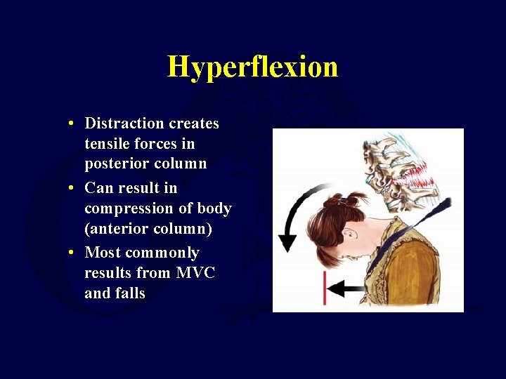 Hyperflexion • Distraction creates tensile forces in posterior column • Can result in compression