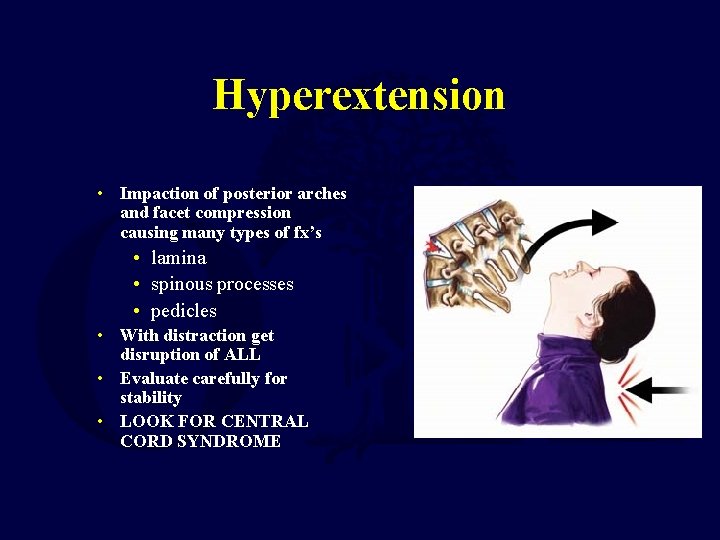 Hyperextension • Impaction of posterior arches and facet compression causing many types of fx’s