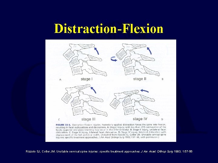 Distraction-Flexion Rizzolo SJ, Cotler JM. Unstable cervical spine injuries: specific treatment approaches. J Am