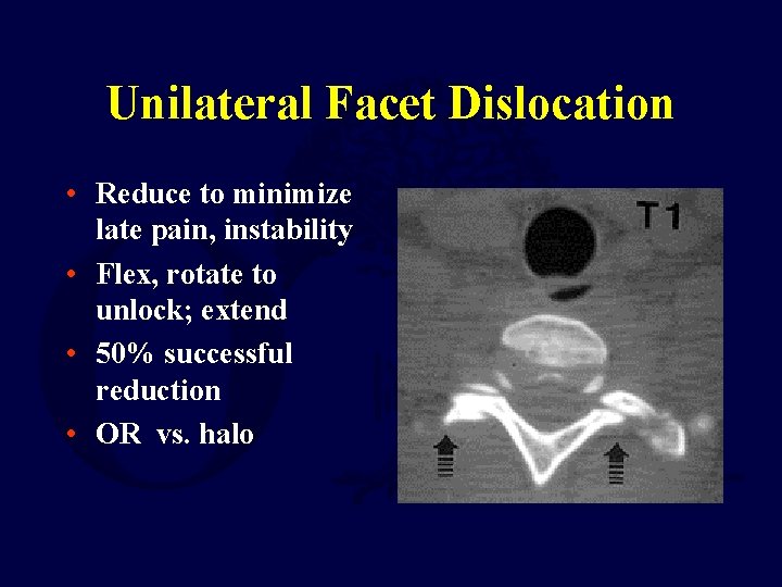 Unilateral Facet Dislocation • Reduce to minimize late pain, instability • Flex, rotate to