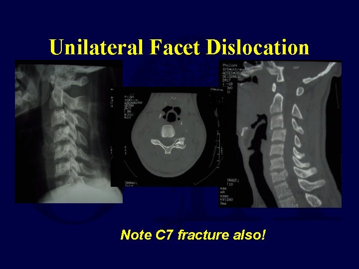 Unilateral Facet Dislocation Note C 7 fracture also! 