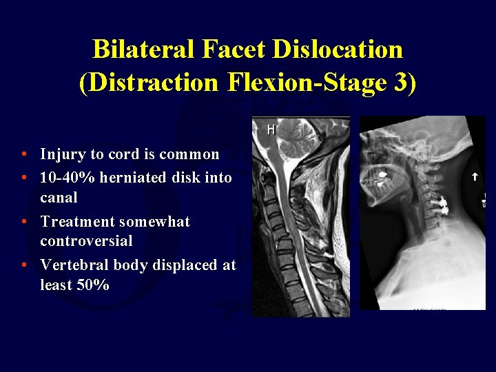 Bilateral Facet Dislocation (Distraction Flexion-Stage 3) • Injury to cord is common • 10