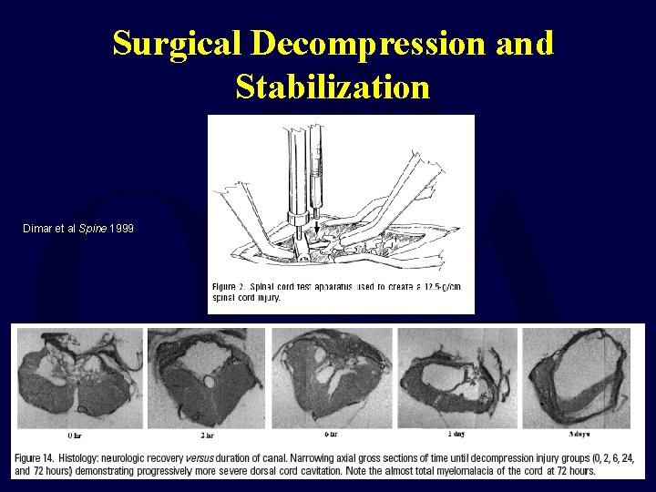 Surgical Decompression and Stabilization Dimar et al Spine 1999 