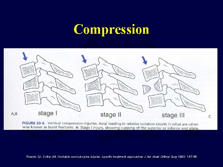 Compression Rizzolo SJ, Cotler JM. Unstable cervical spine injuries: specific treatment approaches. J Am